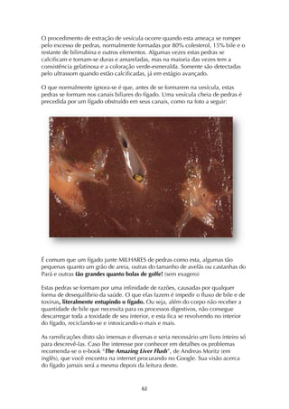 ! &"!
O procedimento de extração de vesícula ocorre quando esta ameaça se romper
pelo excesso de pedras, normalmente formadas por 80% colesterol, 15% bile e o
restante de bilirrubina e outros elementos. Algumas vezes estas pedras se
calcificam e tornam-se duras e amareladas, mas na maioria das vezes tem a
consistência gelatinosa e a coloração verde-esmeralda. Somente são detectadas
pelo ultrassom quando estão calcificadas, já em estágio avançado.
O que normalmente ignora-se é que, antes de se formarem na vesícula, estas
pedras se formam nos canais biliares do fígado. Uma vesícula cheia de pedras é
precedida por um fígado obstruído em seus canais, como na foto a seguir:
É comum que um fígado junte MILHARES de pedras como esta, algumas tão
pequenas quanto um grão de areia, outras do tamanho de avelãs ou castanhas do
Pará e outras tão grandes quanto bolas de golfe! (sem exagero)
Estas pedras se formam por uma infinidade de razões, causadas por qualquer
forma de desequilíbrio da saúde. O que elas fazem é impedir o fluxo de bile e de
toxinas, literalmente entupindo o fígado. Ou seja, além do corpo não receber a
quantidade de bile que necessita para os processos digestivos, não consegue
descarregar toda a toxidade de seu interior, e esta fica se revolvendo no interior
do fígado, reciclando-se e intoxicando-o mais e mais.
As ramificações disto são imensas e diversas e seria necessário um livro inteiro só
para descrevê-las. Caso lhe interesse por conhecer em detalhes os problemas
recomenda-se o e-book “The Amazing Liver Flush”, de Andreas Moritz (em
inglês), que você encontra na internet procurando no Google. Sua visão acerca
do fígado jamais será a mesma depois da leitura deste.
 