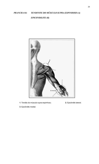 25
PRANCHA 04: TENDINITE DO MÚSCULO SUPRA-ESPINHOSO (A)
EPICONDILITE (B)
1. Tendão do músculo supra-espinhoso; 2. Epicôndilo lateral;
3. Epicôndilo medial.
 