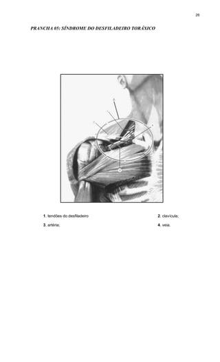 26
PRANCHA 05: SÍNDROME DO DESFILADEIRO TORÁXICO
1. tendões do desfiladeiro 2. clavícula;
3. artéria; 4. veia.
 