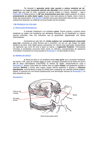 7
Tal situação é agravada ainda mais quando a coluna vertebral sai da
posição em que suas curvaturas naturais são alteradas (como quando nos abaixamos para
pegar algo que está no chão, mantendo as pernas eretas e a coluna “dobrada” – veja a
Ilustração 4). Nesta postura, os NP são arremessados para trás (região posterior do corpo),
pressionando os anéis desta região. Quanto mais esta postura se repete, mais e mais os
anéis são pressionados. A Ilustração 5 também serve para demonstrar este princípio, pois se a
cabeça ficar abaixada, as vértebras cervicais ficarão sob tal condição.
1.B) DOENÇAS DA COLUNA
A. PROTUSÃO INTRADISCAL
A protusão intradiscal é um problema grave. Ocorre quando a postura acima
detalhada se repete com freqüência nas atividades rotineiras de um trabalhador ou mesmo
quando eventuais, mas nos indivíduos que já apresentam degeneração nos discos
intervertebrais.
Caracteriza-se pelo fato do núcleo pulposo ser constantemente empurrado
para trás, rompendo os anéis fibrosos que o envolvem, um por um, até chegar na região
periférica do disco. Esta região passa a apresentar um volume mais acentuado, pressionando
um ligamento que corre de cima a baixo na coluna, o Ligamento Posterior. Terminações
nervosas aí localizadas provocam fortes dores no indivíduo, acompanhadas de espasmos
musculares. É possível ver uma protusão na Ilustração 3, no lado direito do disco.
B. HÉRNIA DE DISCO
A hérnia de disco é um problema ainda mais grave que a protusão intradiscal.
Na hérnia, o NP, após ter rompido todos os anéis, consegue extravasar-se de dentro do anel e
sai do disco intervertebral, empurrando os tecidos da região, pressionando-os (veja a
Ilustração 6, abaixo). Esta lesão se verifica mais na região lombar, principalmente quando o
indivíduo flexiona o tronco para erguer cargas (hérnia posterior) e quando o rotaciona
lateralmente, movimentando a carga da direita para a esquerda, por exemplo (hérnia póstero-
lateral). É possível ver uma hérnia pressionando uma terminação nervosa na Ilustração 3, no
lado esquerdo do disco.
Ilustração 6
Fibras do anel
rompidas
Medula
NP vazado
(hérnia)
Hérnia de disco póstero-lateral
 