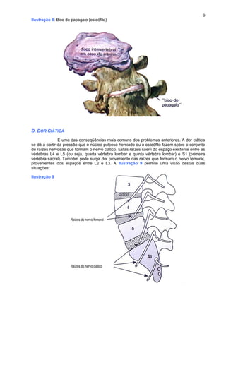 9
Ilustração 8: Bico de papagaio (osteófito)
D. DOR CIÁTICA
É uma das conseqüências mais comuns dos problemas anteriores. A dor ciática
se dá a partir da pressão que o núcleo pulposo herniado ou o osteófito fazem sobre o conjunto
de raízes nervosas que formam o nervo ciático. Estas raízes saem do espaço existente entre as
vértebras L4 e L5 (ou seja, quarta vértebra lombar e quinta vértebra lombar) e S1 (primeira
vértebra sacral). Também pode surgir dor proveniente das raízes que formam o nervo femoral,
provenientes dos espaços entre L2 e L3. A Ilustração 9 permite uma visão destas duas
situações:
Ilustração 9
Raízes do nervo femoral
Raízes do nervo ciático
 