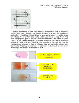 APOSTILA DE HEMATOLOGIA CLÍNICA
Prof. Alípio O Carmo

O esfregaço de sangue é usado para fazer uma diferenciação entre os leucócitos,
isto é, fazer uma contagem do número de neutrófilos, linfócitos, monócitos,
eosinófilos e basófilos. Chegando-se a uma porcentagem de cada célula
encontrada. Usado também para avaliar a série vermelha e as plaquetas. É feito
com uma pequena gota de sangue sendo colocada sobre uma lâmina de vidro,
onde o técnico fará um esfregaço, arrastando a gota de sangue com uma outra
lâmina de vidro, com isso forma-se uma película. O sangue tem que ser
homogenizado antes de se fazer o esfregaço para que as células estejam bem
destribuídas. O esfregaço é corado com Leishman ou Giemsa. E observado em
microscópio com objetiva de aumento de 100X.

4

 