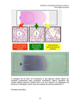 APOSTILA DE HEMATOLOGIA CLÍNICA
Prof. Alípio O Carmo

A vantagem de se fazer um hemograma é que algumas células podem ser
contadas erradamente pelos processos automáticos. Alguns aparelhos não
contam células imaturas e podem levar a um erro quanto a um diagnóstico de
leucemia. O esfregaço, porém, deve ser avaliado por pessoal experiente. ff

Processo automático

5

 