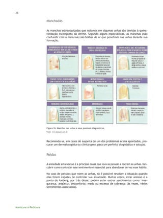 32
Manicure e Pedicure
Figura 20: Psoríase ungueal.
Fonte: http://www.sbd.org.br/doencas/psoriase/.
Disidrose
Disidrose é ...