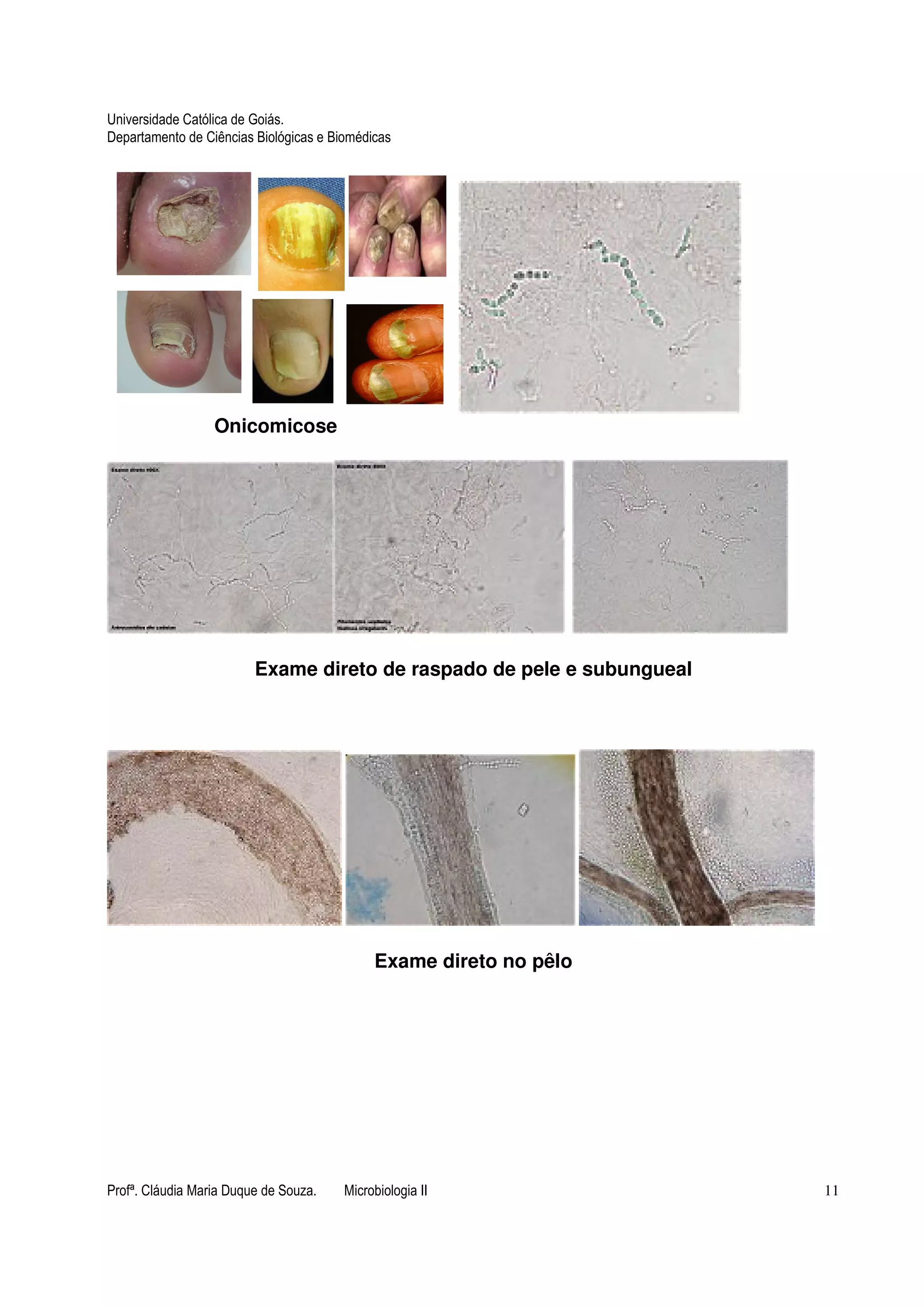 Universidade Católica de Goiás. 
Departamento de Ciências Biológicas e Biomédicas 
Onicomicose 
Exame direto de raspado de pele e subungueal 
Exame direto no pêlo 
Profª. Cláudia Maria Duque de Souza. Microbiologia II 11 
 