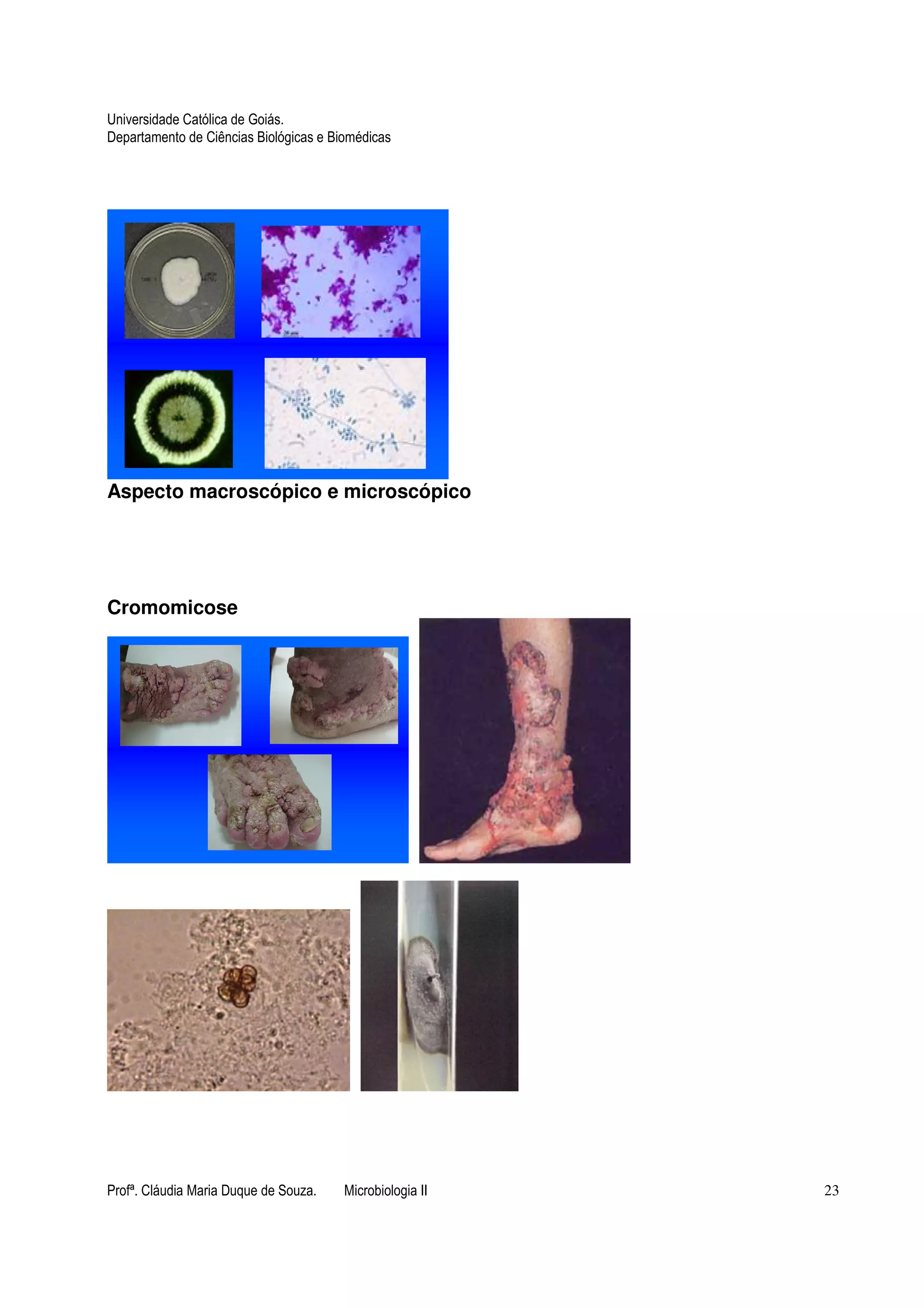 Universidade Católica de Goiás. 
Departamento de Ciências Biológicas e Biomédicas 
Aspecto macroscópico e microscópico 
Cromomicose 
Profª. Cláudia Maria Duque de Souza. Microbiologia II 23 
 
