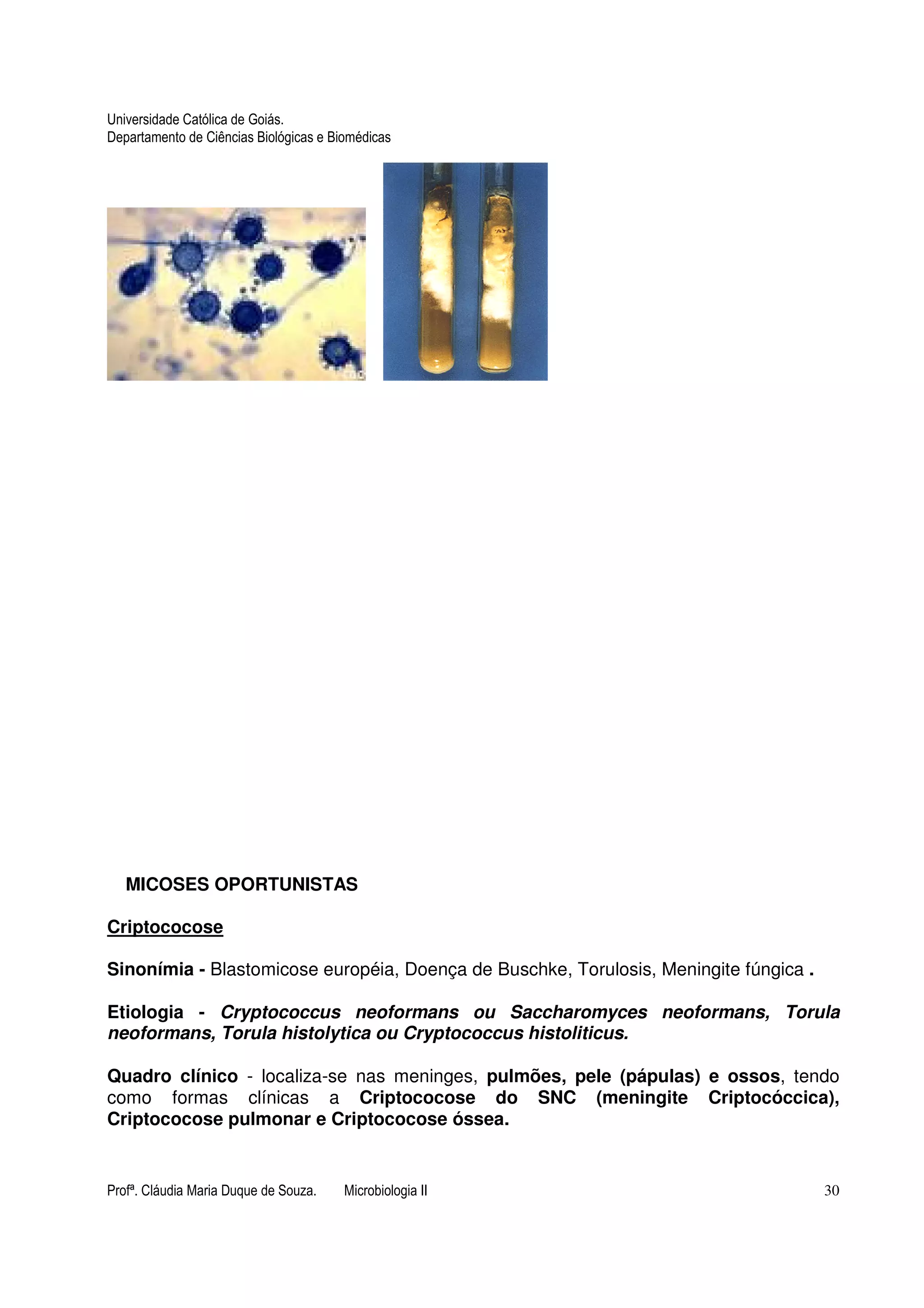 Universidade Católica de Goiás. 
Departamento de Ciências Biológicas e Biomédicas 
MICOSES OPORTUNISTAS 
Criptococose 
Sinonímia - Blastomicose européia, Doença de Buschke, Torulosis, Meningite fúngica . 
Etiologia - Cryptococcus neoformans ou Saccharomyces neoformans, Torula 
neoformans, Torula histolytica ou Cryptococcus histoliticus. 
Quadro clínico - localiza-se nas meninges, pulmões, pele (pápulas) e ossos, tendo 
como formas clínicas a Criptococose do SNC (meningite Criptocóccica), 
Criptococose pulmonar e Criptococose óssea. 
Profª. Cláudia Maria Duque de Souza. Microbiologia II 30 
 