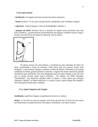 3.1.b) Apoio Incisal
- localização: nos ângulos próximo-incisais dos dentes anteriores.
- forma: de letra “v”( em uma vista proximal), estendendo-se de vestibular a lingual.
- espessura: 1mm de largura e 1mm de profundidade ( mínimos )
- preparo do nicho: primeiro faz-se a remoção do ângulo inciso proximal, com uma
broca cilíndrica , e posteriormente um biselamento dos ângulos vestíbulo-incisal e línguo-
incisal, com uma broca em forma de chama de vela ou cônica.
Os apoios incisais são anti-estéticos, e localizam-se mais afastados do fulcro do
dente, aumentando o braço de alavanca. Além disso, têm um conector menor mais
alongado, o que diminui a rigidez e aumenta o índice de fratura. Utilizando-se de resinas
compostas de ultima geração podemos aumentar o cíngulo dos dentes anteriores( quando
necessário) para determinar uma área apropriada para um apoio lingual, o que faz com
que os apoios incisais sejam pouco utilizados . No entanto, em PPRs chamadas
“periodontais”, que objetivam esplintar todos os dentes, o único apoio que consegue
realmente “abraçar” os dentes anteriores é o incisal, já que o apoio lingual não impede a
movimentação do dente para vestibular.
3.1.c) Apoio Lingual ou de Cíngulo
localização: superfícies linguais ou palatinas de incisivos e caninos
forma: se for feito no meio do cíngulo, terá forma de meia lua. Se feito em um canino
pré-molarizado na região proximal, terá aspecto semelhante a um apoio oclusal.
GEP – Grupo de Estudos em Prótese Curitiba/PR
11
 