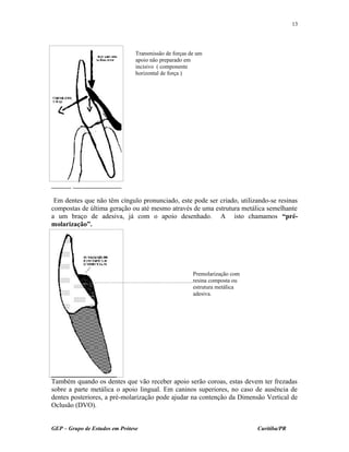 Em dentes que não têm cíngulo pronunciado, este pode ser criado, utilizando-se resinas
compostas de última geração ou até mesmo através de uma estrutura metálica semelhante
a um braço de adesiva, já com o apoio desenhado. A isto chamamos “pré-
molarização”.
Também quando os dentes que vão receber apoio serão coroas, estas devem ter frezadas
sobre a parte metálica o apoio lingual. Em caninos superiores, no caso de ausência de
dentes posteriores, a pré-molarização pode ajudar na contenção da Dimensão Vertical de
Oclusão (DVO).
GEP – Grupo de Estudos em Prótese Curitiba/PR
13
Transmissão de forças de um
apoio não preparado em
incisivo ( componente
horizontal de força )
Premolarização com
resina composta ou
estrutura metálica
adesiva.
 