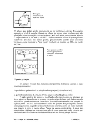 Os planos-guia podem existir naturalmente, ou ser melhorados, através de pequenos
desgastes a nível de esmalte. Quando os pilares são coroas totais os planos-guia são
planejados e executados já frezados nas coroas.( veja mais sobre plano-guia nos tópicos
“ Preparo da boca” e “PLANEJAMENTO”.) Podemos também utilizar de planos guia nas
superfícies proximais dos dentes pilares, principalmente quando estes estiverem
inclinados, para minimizar a “área morta” resultante da inserção da PPR., na região
cervical.
Tipos de grampos
Os grampos possuem duas maneiras completamente distintas de alcançar as áreas
retentivas dos dentes:
1- partindo do apoio oclusal, na direção ocluso-gengival ( circunferenciais)
2- partindo diretamente da sela , na direção gengivo-oclusal ( ação de ponta)
A ação retentiva do grampo é modificada pela maneira com que alcançam as
áreas retentivas. Dessa forma, os grampos circunferenciais deslizam mais facilmente pela
superfície ( quando submetidos a uma força de remoção) comparados aos grampos de
ação de ponta. STONE, descrevendo esse efeito dos grampos de ação de ponta, fez uma
analogia pertinente, alegando ser mais fácil arrastar uma tábua sobre um plano inclinado
que empurrá-la sobre o mesmo plano. Apesar de alguma controvérsia , é quase que
unanimidade a idéia de que os grampos de ação de ponta apresentam maior retenção que
os circunferenciais. Outras características diferenciam um tipo de grampo do outro:
GEP – Grupo de Estudos em Prótese Curitiba/PR
17
Plano-guia
determinado em
superfície lingual
Plano-guia em superfície
proximal, para reduzir a
‘área morta” determinada
na ameia.
 