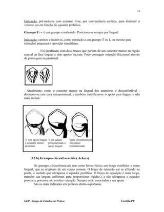 Indicação: pré-molares com extremo livre, por conveniência estética, para diminuir o
volume, ou em função do equador protético.
Grampo Y: - é um grampo combinado. Posiciona-se sempre por lingual.
Indicação: caninos e incisivos, como oposição a um grampo T ou I, ou mesmo para
retenção( pequena) e oposição simultânea.
Foi idealizado com dois braços que partem de um conector menor na região
central da face lingual e dois apoios incisais. Pode conseguir retenção friccional através
de plano-guia na proximal.
. Atualmente, como o conector menor na lingual dos anteriores é desconfortável ,
deslocou-se este para interproximal, e também modificou-se o apoio para lingual e não
mais incisal.
3.2.b) Grampos circunferenciais ( Ackers)
Os grampos circunferenciais tem como forma básica um braço vestibular e outro
lingual, que se originam de um corpo comum. O braço de retenção vai se afilando na
ponta, à medida que ultrapassa o equador protético. O braço de oposição é mais largo,
mantém sua largura uniforme( para proporcionar rigidez.), e não ultrapassa o equador
protético, portanto não confere retenção. Sempre estão associados a um apoio.
São os mais indicados em próteses dento-suportadas.
GEP – Grupo de Estudos em Prótese Curitiba/PR
19
Y com apoio lingual
e conector menor
proximal
Y em canino
premolarizado c/
apoio lingual
Semi-circunferencial
em canino
premolarizado
 