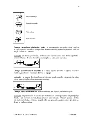 Grampo circunferencial simples ( Ackers ): composto de um apoio oclusal contíguo
ao espaço protético e dois braços partindo do apoio em direção à outra proximal, onde um
braço vai buscar a retenção.
Indicação: em dentes posteriores, próteses dento-suportadas ou áreas dento-suportadas (
uma modificação de uma classe II, por exemplo, no lado dento-suportado )
Grampo circunferencial invertido : o apoio oclusal encontra-se oposto ao espaço
protético, e os braços partem em direção ao espaço.
Indicação: a mesma do circunferencial simples, usado quando a retenção favorável
estiver na proximal contígua ao espaço protético.
Grampo semi-circunferencial: só tem um braço por lingual, partindo do apoio.
Indicação: em pré-molares ou caninos pré-molarizados, como oposição a um grampo tipo
Roach.. ( em extremos livres) . Pode ser usado também como retentor, quando a prótese
for dento-suportada, a retenção exigida não seja grande( pequeno espaço protético), e
deseja-se melhor estética.
GEP – Grupo de Estudos em Prótese Curitiba/PR
20
Braço de retenção
Braço de oposição
Vista oclusal
Vista proximal
 