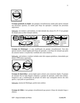 Grampo geminado ou duplo: são grampos circunferenciais unidos pelo apoio( retenção
nas proximais opostas), ou unidos pelo braço de oposição ( retenção nas proximais
adjacentes).
Indicação: em molares e pré-molares, no lado dentado das classes II e IV. É um grampo
de eleição para se obter retenção indireta.
Grampo de Ottolengui : é uma modificação do grampo circunferencial. Tem dois
apoios( mesial e distal) ligados pelo braço de oposição, e um braço de retenção que parte
do conector menor e vai pela face vestibular até a área retentiva.
Indicação: pré-molares e molares isolados entre dois espaços protéticos, intercalados por
dentes ( PPR dento-suportada).
Grampo de Queirelhac: possui duplo apoio oclusal, com conectores duplos. O grampo
de retenção fica no lado lingual e dispensa o grampo de oposição, sendo mais estético.
Imagina-se que a estabilização da posição do dente seja conseguida através dos dois
apoios, o que pode ser questionável.
Indicação: mesma do Ottolengui, porém mais estético.
Grampo de Gillet: é um grampo circunferencial que possui o braço de retenção longo e
elástico.
GEP – Grupo de Estudos em Prótese Curitiba/PR
21
Geminados
unidos pelo
braço de
oposição
Geminados
unidos pelo
apoio
 