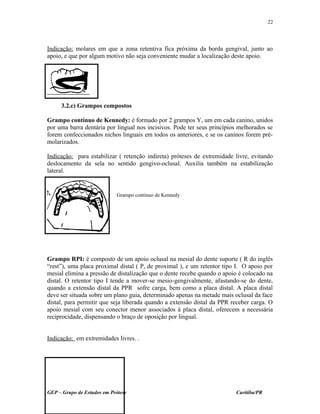 Indicação: molares em que a zona retentiva fica próxima da borda gengival, junto ao
apoio, e que por algum motivo não seja conveniente mudar a localização deste apoio.
3.2.c) Grampos compostos
Grampo contínuo de Kennedy: é formado por 2 grampos Y, um em cada canino, unidos
por uma barra dentária por lingual nos incisivos. Pode ter seus princípios melhorados se
forem confeccionados nichos linguais em todos os anteriores, e se os caninos forem pré-
molarizados.
Indicação: para estabilizar ( retenção indireta) próteses de extremidade livre, evitando
deslocamento da sela no sentido gengivo-oclusal. Auxilia também na estabilização
lateral.
Grampo RPI: é composto de um apoio oclusal na mesial do dente suporte ( R do inglês
“rest”), uma placa proximal distal ( P, de proximal ), e um retentor tipo I. O apoio por
mesial elimina a pressão de distalização que o dente recebe quando o apoio é colocado na
distal. O retentor tipo I tende a mover-se mesio-gengivalmente, afastando-se do dente,
quando a extensão distal da PPR sofre carga, bem como a placa distal. A placa distal
deve ser situada sobre um plano guia, determinado apenas na metade mais oclusal da face
distal, para permitir que seja liberada quando a extensão distal da PPR receber carga. O
apoio mesial com seu conector menor associados à placa distal, oferecem a necessária
reciprocidade, dispensando o braço de oposição por lingual.
Indicação: em extremidades livres. .
GEP – Grupo de Estudos em Prótese Curitiba/PR
22
Grampo contínuo de Kennedy
 