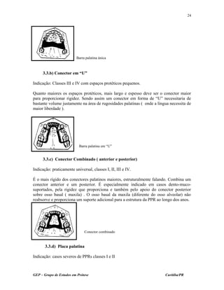 3.3.b) Conector em “U”
Indicação: Classes III e IV com espaços protéticos pequenos.
Quanto maiores os espaços protéticos, mais largo e espesso deve ser o conector maior
para proporcionar rigidez. Sendo assim um conector em forma de “U” necessitaria de
bastante volume justamente na área de rugosidades palatinas ( onde a língua necessita de
maior liberdade ).
3.3.c) Conector Combinado ( anterior e posterior)
Indicação: praticamente universal, classes I, II, III e IV.
É o mais rígido dos conectores palatinos maiores, estruturalmente falando. Combina um
conector anterior e um posterior. É especialmente indicado em casos dento-muco-
suportados, pela rigidez que proporciona e também pelo apoio do conector posterior
sobre osso basal ( maxila) . O osso basal da maxila (diferente do osso alveolar) não
reabsorve e proporciona um suporte adicional para a estrutura da PPR ao longo dos anos.
3.3.d) Placa palatina
Indicação: casos severos de PPRs classes I e II
GEP – Grupo de Estudos em Prótese Curitiba/PR
24
Barra palatina única
Barra palatina em “U”
Conector combinado
 