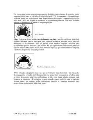 Em casos onde temos poucos remanescentes dentários, necessitamos do conector maior
para auxiliar no suporte, retenção direta e indireta da PPR. Nesses casos a placa palatina é
indicada, sendo um recobrimento total do palato que proporciona também suporte sobre
osso basal. Deve ser delgada e reproduzir as rugosidades palatinas. Nas áreas dentadas
mantém o afastamento de 6 mm da margem gengival.
Obs . Podem ser feitos também recobrimentos parciais ( anterior, médio ou posterior),
também delgados, porém indicados para espaços protéticos menores, onde não seja
necessário o recobrimento total do palato. Uma situação bastante utilizada para
recobrimento parcial anterior é em classes IV que apresentam considerável perda do
rebordo anterior. O conector maior pode então ser rígido( já que apresenta maior largura),
e podemos dispensar o conector posterior.
Outra situação conveniente para o uso do recobrimento parcial anterior é em classes I e
II em pacientes operados periodontalmente que apresentam passagem de ar/saliva entre
as raízes dos dentes anteriores, dificultando a fala. Uma placa palatina anterior pode
bloquear a passagem de ar/saliva, proporcionando maior conforto para o paciente.
Nesses casos, no entanto, seria conveniente também o conector posterior para
proporcionar melhor apoio sobre osso basal .
GEP – Grupo de Estudos em Prótese Curitiba/PR
25
Placa palatina
Recobrimento parcial anterior
 