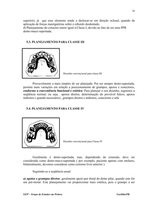 superior), já que esse elemento tende a deslocar-se em direção oclusal, quando da
aplicação de forças mastigatórias sobre o rebordo desdentado.
d) Planejamento do conector maior igual à Classe I, devido ao fato de ser uma PPR
dento-muco-suportada.
5.3. PLANEJAMENTO PARA CLASSE III
Provavelmente a mais simples de ser planejada. Por ser sempre dento-suportada,
permite mais variações em relação a posicionamento de grampos, apoios e conectores,
conforme a conveniência funcional e estética. Para planejar o seu desenho, seguimos a
seqüência normal, ou seja, apoios diretos, determinação do provável fulcro, apoios
indiretos ( quando necessário) , grampos diretos e indiretos, conectores e sela
5.4. PLANEJAMENTO PARA CLASSE IV
Geralmente é dento-suportada, mas, dependendo da extensão, deve ser
considerada como dento-muco-suportada ( por exemplo, paciente apenas com molares,
bilateralmente, devemos considerar como extremo livre anterior ).
Seguindo-se a seqüência usual:
a) apoios e grampos diretos: geralmente apoio por distal do dente pilar, quando este for
um pré-molar. Este planejamento vai proporcionar mais estética, pois o grampo a ser
GEP – Grupo de Estudos em Prótese Curitiba/PR
36
Desenho convencional para classe III
Desenho convencional para Classe IV
 