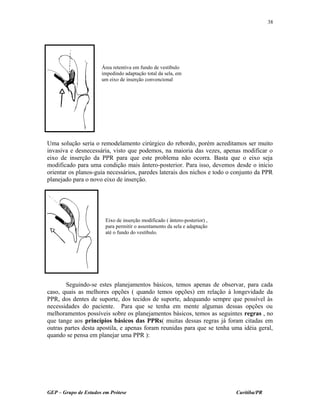 Uma solução seria o remodelamento cirúrgico do rebordo, porém acreditamos ser muito
invasiva e desnecessária, visto que podemos, na maioria das vezes, apenas modificar o
eixo de inserção da PPR para que este problema não ocorra. Basta que o eixo seja
modificado para uma condição mais ântero-posterior. Para isso, devemos desde o início
orientar os planos-guia necessários, paredes laterais dos nichos e todo o conjunto da PPR
planejado para o novo eixo de inserção.
Seguindo-se estes planejamentos básicos, temos apenas de observar, para cada
caso, quais as melhores opções ( quando temos opções) em relação à longevidade da
PPR, dos dentes de suporte, dos tecidos de suporte, adequando sempre que possível às
necessidades do paciente. Para que se tenha em mente algumas dessas opções ou
melhoramentos possíveis sobre os planejamentos básicos, temos as seguintes regras , no
que tange aos princípios básicos das PPRs( muitas dessas regras já foram citadas em
outras partes desta apostila, e apenas foram reunidas para que se tenha uma idéia geral,
quando se pensa em planejar uma PPR ):
GEP – Grupo de Estudos em Prótese Curitiba/PR
38
Área retentiva em fundo de vestíbulo
impedindo adaptação total da sela, em
um eixo de inserção convencional
Eixo de inserção modificado ( ântero-posterior) ,
para permitir o assentamento da sela e adaptação
até o fundo do vestíbulo.
 