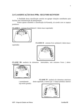 2) CLASSIFICAÇÃO DAS PPRs SEGUNDO KENNEDY
A finalidade dessa classificação consiste em agrupar situações semelhantes para
facilitar uma sistematização do planejamento.
Vamos apenas relembrar a classificação de Kennedy, de acordo com os espaços
protéticos:
CLASSE I - extremo livre bilateral ( dento-muco-suportada)
CLASSE II - extremo livre unilateral ( dento-muco-
suportada)
CLASSE III- ausência de elementos intercalados, sem extremos livres ( dento-
suportada)
CLASSE IV- ausência de elementos anteriores
( normalmente dento-suportada, a menos que o espaço protético anterior
seja muito grande)
GEP – Grupo de Estudos em Prótese Curitiba/PR
6
 