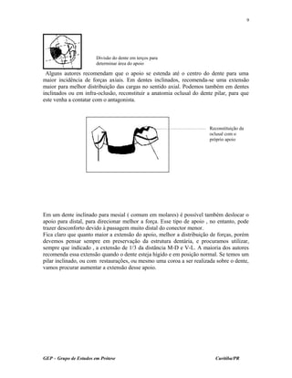 Alguns autores recomendam que o apoio se estenda até o centro do dente para uma
maior incidência de forças axiais. Em dentes inclinados, recomenda-se uma extensão
maior para melhor distribuição das cargas no sentido axial. Podemos também em dentes
inclinados ou em infra-oclusão, reconstituir a anatomia oclusal do dente pilar, para que
este venha a contatar com o antagonista.
Em um dente inclinado para mesial ( comum em molares) é possível também deslocar o
apoio para distal, para direcionar melhor a força. Esse tipo de apoio , no entanto, pode
trazer desconforto devido à passagem muito distal do conector menor.
Fica claro que quanto maior a extensão do apoio, melhor a distribuição de forças, porém
devemos pensar sempre em preservação da estrutura dentária, e procuramos utilizar,
sempre que indicado , a extensão de 1/3 da distância M-D e V-L. A maioria dos autores
recomenda essa extensão quando o dente esteja hígido e em posição normal. Se temos um
pilar inclinado, ou com restaurações, ou mesmo uma coroa a ser realizada sobre o dente,
vamos procurar aumentar a extensão desse apoio.
GEP – Grupo de Estudos em Prótese Curitiba/PR
9
Divisão do dente em terços para
determinar área do apoio
Reconstituição da
oclusal com o
próprio apoio
 