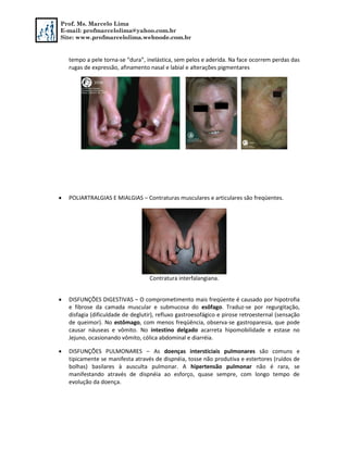 Prof. Ms. Marcelo Lima
E-mail: profmarcelolima@yahoo.com.br
Site: www.profmarcelolima.webnode.com.br
tempo a pele torna-se “dura”, inelástica, sem pelos e aderida. Na face ocorrem perdas das
rugas de expressão, afinamento nasal e labial e alterações pigmentares
 POLIARTRALGIAS E MIALGIAS – Contraturas musculares e articulares são freqüentes.
Contratura interfalangiana.
 DISFUNÇÕES DIGESTIVAS – O comprometimento mais freqüente é causado por hipotrofia
e fibrose da camada muscular e submucosa do esôfago. Traduz-se por regurgitação,
disfagia (dificuldade de deglutir), refluxo gastroesofágico e pirose retroesternal (sensação
de queimor). No estômago, com menos freqüência, observa-se gastroparesia, que pode
causar náuseas e vômito. No intestino delgado acarreta hipomobilidade e estase no
Jejuno, ocasionando vômito, cólica abdominal e diarréia.
 DISFUNÇÕES PULMONARES – As doenças intersticiais pulmonares são comuns e
tipicamente se manifesta através de dispnéia, tosse não produtiva e estertores (ruídos de
bolhas) basilares à ausculta pulmonar. A hipertensão pulmonar não é rara, se
manifestando através de dispnéia ao esforço, quase sempre, com longo tempo de
evolução da doença.
 