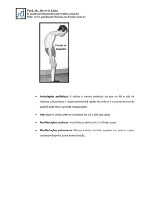 Prof. Ms. Marcelo Lima
E-mail: profmarcelolima@yahoo.com.br
Site: www.profmarcelolima.webnode.com.br
 Articulações periféricas: A artrite é menos simétrica do que na AR e não há
nódulos subcutâneos. Freqüentemente há rigidez de ombros e o acometimento do
quadril pode levar a grande incapacidade.
 Irite: Ocorre uveite anterior unilateral em 10 a 20% dos casos.
 Manifestações cardíacas: Insuficiência aórtica em 2 a 5% dos casos.
 Manifestações pulmonares: Fibrose crônica do lobo superior em poucos casos,
causando dispnéia, tosse expectoração.
Posição de
Esquiador
 