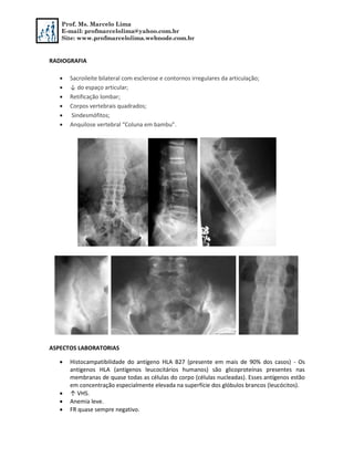 Prof. Ms. Marcelo Lima
E-mail: profmarcelolima@yahoo.com.br
Site: www.profmarcelolima.webnode.com.br
RADIOGRAFIA
 Sacroileíte bilateral com esclerose e contornos irregulares da articulação;
 ↓ do espaço articular;
 Retificação lombar;
 Corpos vertebrais quadrados;
 Sindesmófitos;
 Anquilose vertebral “Coluna em bambu”.
ASPECTOS LABORATORIAS
 Histocampatibilidade do antígeno HLA B27 (presente em mais de 90% dos casos) - Os
antígenos HLA (antígenos leucocitários humanos) são glicoproteínas presentes nas
membranas de quase todas as células do corpo (células nucleadas). Esses antígenos estão
em concentração especialmente elevada na superfície dos glóbulos brancos (leucócitos).
 ↑ VHS.
 Anemia leve.
 FR quase sempre negativo.
 
