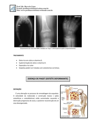 Prof. Ms. Marcelo Lima
E-mail: profmarcelolima@yahoo.com.br
Site: www.profmarcelolima.webnode.com.br
Arqueamento dos ossos dos MMII, metáfise em “taça” e diminuição da epífise (respectivamente).
TRATAMENTO
 Dieta rica em cálcio e vitamina D.
 Suplementação de cálcio e vitamina D.
 Exposição a luz solar.
 Seqüelas podem ser tratadas com osteotomias corretivas.
DEFINIÇÃO
É uma alteração no processo de remodelagem do esqueleto.
A velocidade da reabsorção e construção ósseas ( ações
osteolíticas e osteoblásticas) estão aumentadas causando a
destruição progressiva de ossos, e posterior reconstrução de um
osso desorganizado.
DOENÇA DE PAGET (OSTEÍTE DEFORMANTE)
 