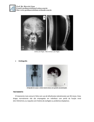 Prof. Ms. Marcelo Lima
E-mail: profmarcelolima@yahoo.com.br
Site: www.profmarcelolima.webnode.com.br
Crânio com Paget, tíbia normal e com Paget.
 Cintilografia
Cintigrafia do corpo e crânio mostra áreas com grande vascularização.
TRATAMENTO
O tratamento mais comum é feito com uso de bifosfonatos (alendronato), por 06 meses. Estas
drogas normalmente não são empregadas em indivíduos com perda da função renal
(Clcr<35ml/min), ou naqueles com história de esofagite ou problemas dispépticos.
 