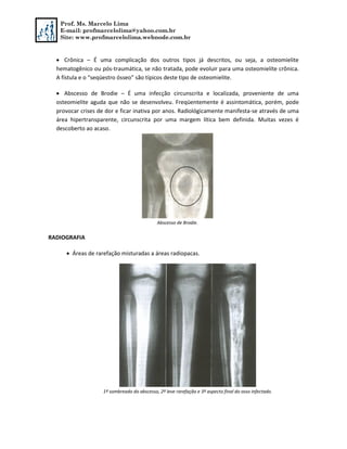 Prof. Ms. Marcelo Lima
E-mail: profmarcelolima@yahoo.com.br
Site: www.profmarcelolima.webnode.com.br
 Crônica – É uma complicação dos outros tipos já descritos, ou seja, a osteomielite
hematogênico ou pós-traumática, se não tratada, pode evoluir para uma osteomielite crônica.
A fístula e o “seqüestro ósseo” são típicos deste tipo de osteomielite.
 Abscesso de Brodie – É uma infecção circunscrita e localizada, proveniente de uma
osteomielite aguda que não se desenvolveu. Freqüentemente é assintomática, porém, pode
provocar crises de dor e ficar inativa por anos. Radiológicamente manifesta-se através de uma
área hipertransparente, circunscrita por uma margem lítica bem definida. Muitas vezes é
descoberto ao acaso.
Abscesso de Brodie.
RADIOGRAFIA
 Áreas de rarefação misturadas a áreas radiopacas.
1º sombreado do abscesso, 2º leve rarefação e 3º aspecto final do osso infectado.
 