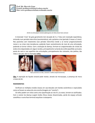 Prof. Ms. Marcelo Lima
E-mail: profmarcelolima@yahoo.com.br
Site: www.profmarcelolima.webnode.com.br
Artrite na articulação metatarsofalangeana do hálux (local mais comum)
A chamada "crise" de gota geralmente tem duração de 5 a 7 dias com resolução espontânea,
entrando num período intercrítico (assintomático), até a próxima crise (período 3 meses a 2 anos).
Nos pacientes sem tratamento esse período intercrítico tende a se tornar progressivamente
menor e as crises mais duradouras; podendo haver acometimento de mais de uma articulação,
podendo se tornar crônica. Com a evolução da doença, formam-se congromerados de cristais de
ácido úrico depositados em alguns tecidos, principalmente na borda da orelha (pavilhão auricular),
ponta do nariz e nas superfície das articulações, principalmente dos cotovelos, dos joelhos, das
mãos e dos pés; são os chamados tofos.
Tofos presentes na mão, cotovelo e orelha (respectivamente).
Obs: A aspiração do liquido sinovial pode revelar, através da microscopia, a presença de micro
cristais de AU.
RADIOGRAFIAS
Verificam-se múltiplas erosões ósseas em saca-bocado com bordos escleróticos e espiculados
como se fossem as valvas de uma concha (imagem em "concha").
Os tofos podem ser vistos como uma opacificação ao raio X e, às vezes, tornam-se calcificados.
Com o evoluir da doença surgem lesões líticas ósseas disseminadas, perda do espaço articular
osteófitos e numa fase terminal anquilose e osteopenia
 