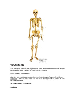 TRAUMATISMOS
São alterações sofridas pelo organismo e estão diretamente relacionadas à ação
de um agente físico e à força de impacto com o mesmo.

Estão divididos em dois tipos:

Abertos - são aqueles que apresentam rompimento da pele/tegumento cutâneo.
Fechados - são aqueles onde não há lesão do tegumento cutâneo. A pele
permanece íntegra.

TRAUMATISMOS FECHADOS

Contusão
 