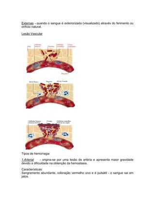 Externas - quando o sangue é exteriorizado (visualizado) através do ferimento ou
orifício natural.

Lesão Vascular




Tipos de hemorragia

1.Arterial    - origina-se por uma lesão de artéria e apresenta maior gravidade
devido a dificuldade na obtenção da hemostasia.

Características:
Sangramento abundante, coloração vermelho vivo e é pulsátil - o sangue sai em
jatos.
 