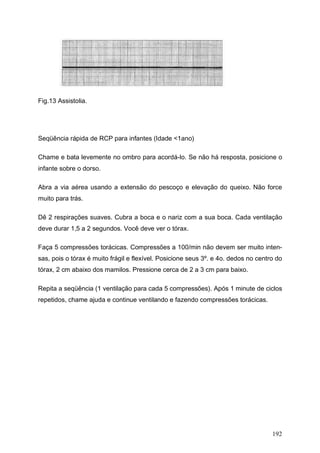Fig.13 Assistolia.




Seqüência rápida de RCP para infantes (Idade <1ano)

Chame e bata levemente no ombro para acordá-lo. Se não há resposta, posicione o
infante sobre o dorso.

Abra a via aérea usando a extensão do pescoço e elevação do queixo. Não force
muito para trás.

Dê 2 respirações suaves. Cubra a boca e o nariz com a sua boca. Cada ventilação
deve durar 1,5 a 2 segundos. Você deve ver o tórax.

Faça 5 compressões torácicas. Compressões a 100/min não devem ser muito inten-
sas, pois o tórax é muito frágil e flexível. Posicione seus 3º. e 4o. dedos no centro do
tórax, 2 cm abaixo dos mamilos. Pressione cerca de 2 a 3 cm para baixo.

Repita a seqüência (1 ventilação para cada 5 compressões). Após 1 minute de ciclos
repetidos, chame ajuda e continue ventilando e fazendo compressões torácicas.




                                                                                    192
 