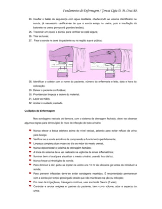 186
24. Insuflar o balão de segurança com água destilada, obedecendo ao volume identificado na
sonda; (é necessário certificar -se de que a sonda esteja na uretra, pois a insuflação do
balonete na uretra provoca rá grandes lesões);
25. Tracionar um pouco a sonda, para verificar se está segura;
26. Tirar as luvas;
27. Fixar a sonda na coxa do paciente ou na região supra -púbica;

28. Identificar o coletor com o nome do paciente, número da enfermaria e leito, data e hora da
colocação;
29. Deixar o paciente confortável;
30. Providenciar limpeza e ordem do material;
31. Lavar as mãos;
32. Anotar o cuidado prestado.
Cuidados de Enfermagem
Nas sondagens vesicais de demora, com o sistema de drenagem fechado, deve -se observar
algumas regras para diminui ção do risco de infecção do trato urinário:
Nunca elevar a bolsa coletora acima do nível vesical, zelando para evitar refluxo da urina
para bexiga;
Verificar se a sonda está livre de compressão e funcionando perfeitamente;
Limpeza completa duas vezes ao di a ao redor do meato uretral;
Nunca desconectar o sistema de drenagem fechado;
A troca do sistema deve ser realizado na vigência de sinais inflamatórios;
Iluminar bem o local para visualizar o meato urinário, usando foco de luz;
Nunca forçar a introdução da sonda;
Para diminuir a dor, pode-se injetar na uretra uns 10 ml de xilocaína gel antes de introduzir a
sonda;
Para prevenir infecções deve -se evitar sondagens repetidas. É recomendado permanecer
com a sonda por tempo prolongado desde que não manifeste rea ção ou infecção;
Em caso de irrigação ou drenagem contínua, usar sonda de Owens (3 vias);
Controlar e anotar reações e queixas do paciente, bem como volume, odor e aspecto da
urina;

 