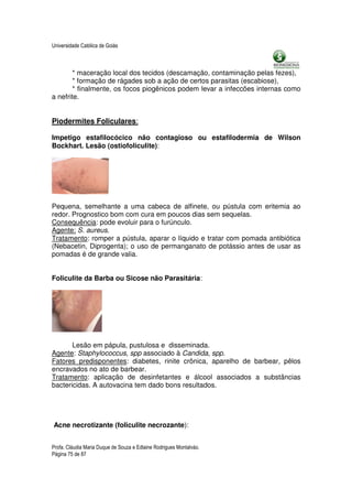 Universidade Católica de Goiás



        * maceração local dos tecidos (descamação, contaminação pelas fezes),
        * formação de rágades sob a ação de certos parasitas (escabiose),
        * finalmente, os focos piogênicos podem levar a infeccões internas como
a nefrite.


Piodermites Foliculares:

Impetigo estafilocócico não contagioso ou estafilodermia de Wilson
Bockhart. Lesão (ostiofoliculite):




Pequena, semelhante a uma cabeca de alfinete, ou pústula com eritemia ao
redor. Prognostico bom com cura em poucos dias sem sequelas.
Consequência: pode evoluir para o furúnculo.
Agente: S. aureus.
Tratamento: romper a pústula, aparar o líquido e tratar com pomada antibiótica
(Nebacetin, Diprogenta); o uso de permanganato de potássio antes de usar as
pomadas é de grande valia.


Foliculite da Barba ou Sicose não Parasitária:




       Lesão em pápula, pustulosa e disseminada.
Agente: Staphylococcus, spp associado à Candida, spp.
Fatores predisponentes: diabetes, rinite crônica, aparelho de barbear, pêlos
encravados no ato de barbear.
Tratamento: aplicação de desinfetantes e álcool associados a substâncias
bactericidas. A autovacina tem dado bons resultados.




Acne necrotizante (foliculite necrozante):


Profa. Cláudia Maria Duque de Souza e Edlaine Rodrigues Montalváo.
Página 75 de 87
 