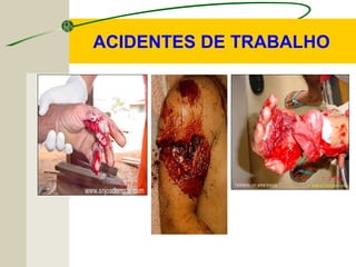 ACIDENTES DE TRABALHO
 