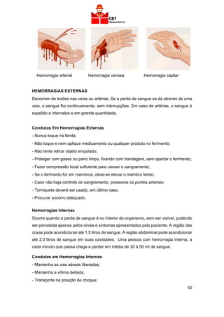 60
Hemorragia arterial Hemorragia venosa Hemorragia capilar
HEMORRAGIAS EXTERNAS
Decorrem de lesões nas veias ou artérias. Se a perda de sangue se dá através de uma
veia, o sangue flui continuamente, sem interrupções. Em caso de artérias, o sangue é
expelido a intervalos e em grande quantidade.
Condutas Em Hemorragias Externas
- Nunca toque na ferida;
- Não toque e nem aplique medicamento ou qualquer produto no ferimento;
- Não tente retirar objeto empalado;
- Proteger com gases ou pano limpo, fixando com bandagem, sem apertar o ferimento;
- Fazer compressão local suficiente para cessar o sangramento;
- Se o ferimento for em membros, deve-se elevar o membro ferido;
- Caso não haja controle do sangramento, pressione os pontos arteriais;
- Torniquete deverá ser usado, em último caso.
- Procurar socorro adequado.
Hemorragias Internas
Ocorre quando a perda de sangue é no interior do organismo, sem ser visível, podendo
ser percebida apenas pelos sinais e sintomas apresentados pelo paciente. A região das
coxas pode acondicionar até 1,5 litros de sangue. A região abdominal pode acondicionar
até 2,0 litros de sangue em suas cavidades. Uma pessoa com hemorragia interna, a
cada minuto que passa chega a perder em média de 30 à 50 ml de sangue.
Condutas em Hemorragias Internas
- Mantenha as vias aéreas liberadas;
- Mantenha a vítima deitada;
- Transporte na posição de choque;
 