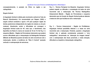 Apostila de Curso para Técnicas em Radiodiagnósticos Odontológicos
conseqüentemente, à posição do Filme na região a ser
radiografada.
Ângulo Vertical:
A Angulação Vertical é obtida pelo movimento vertical do Tubo de
Raios-X (Goniômetro). Foi recomendado por Rapper (1925) o
angulo vertical constante e igual a +8º para qualquer região de
dentes posteriores (independente da região de molares ou de pré-
molares). Atualmente, existe a difículdade em conseguir a
Angulação Vertical exata de +8º, visto que, o Goniômetro, dos
Aparelhos de Raios X, marca em escala de 10 em 10. Na Fig. 2 o
esquema (Maxila – Região de Pré-molares) demonstra que poderá
ocorrer dificuldade para a interpretação da Radiografia Periapical
(Método da Bissetriz) quando da lesão de cárie encontra-se sob a
restauração, devido a incidência do “Raio X Central” (posição
vertical) e a sobreposição de estruturas.
Fig. 2 – Técnica Periapical da Bissetriz: Angulação Vertical,
poderá impedir ou dificultar a constatação de lesão de cárie
recorrente sob a restauração. Na Técnica Radiográfica
Interproximal (Maxila – Região de Pré-molares) o esquema
demonstra que em função do Ângulo Vertical pode-se detectar
a lesão de cárie que localiza-se sob a restauração
Fig. 3 – Técnica Interproximal – Região de Pré-Molares:
Angulação Vertical possibilita detectar a a lesão de cárie
recorrente sob a restauração. Portanto, quando a Angulação
Vertical não é aplicada corretamente produzirá o “erro
radiográfico” denominado de “distorção da imagem dental”
com a sobreposição das faces proximais, e nesta situação,
dificultará ou impedirá a interpretação radiográfica.
Professora Mariana Marcelino – aulasaude@hotmail.com 22
 