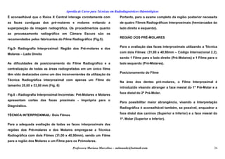 Apostila de Curso para Técnicas em Radiodiagnósticos Odontológicos
É aconselhável que o Raios X Central interage corretamente com
as faces contíguas dos pré-molares e molares evitando a
superposição da imagem radiográfica. Os procedimentos quanto
ao processamento radiográfico em Câmara Escura são os
recomendados pelos fabricantes do Filme Radiográfico (Fig.5).
Fig.5- Radiografia Interproximal: Região dos Pré-molares e dos
Molares – Lado Direito
As dificuldades de posicionamento do Filme Radiográfico e a
centralização de todas as áreas radiografadas em um único filme
têm sido destacadas como um dos inconvenientes da utilização da
Técnica Radiográfica Interproximal com apenas um Filme do
tamanho 26,60 x 53,60 mm (Fig. 6)
Fig.6 - Radiografia Interproximal Incorretas: Pré-Molares e Molares
apresentam cortes das faces proximais - Imprópria para o
Diagnóstico.
TÉCNICA INTERPROXIMAIL: Dois Filmes
Para a adequada avaliação de todas as faces interproximais das
regiões dos Pré-molares e dos Molares emprega-se a Técnica
Radiográfica com dois Filmes (31,00 x 40,90mm), sendo um Filme
para a região dos Molares e um Filme para os Prémolares.
Portanto, para o exame completo da região posterior necessita
de quatro Filmes Radiográficos Interproximais (hemiarcadas do
lado direito e esquerdo).
REGIÃO DOS PRÉ-MOLARES
Para a avaliação das faces interproximais utilizando a Técnica
com dois Filmes: (31,00 x 40,90mm – Código Internacional 2.2),
sendo 1 Filme para o lado direito (Pré-Molares) e 1 Filme para o
lado esquerdo (Pré-Molares).
Posicionamento do Filme
Na área dos dentes pré-molares, o Filme Interproximal é
introduzido visando abranger a face mesial do 1º Pré-Molar e a
face distal do 2º Pré-Molar.
Para possibilitar maior abrangência, visando a Interpretação
Radiográfica é aconselhável também, se possível, enquadrar a
face distal dos caninos (Superior e Inferior) e a face mesial do
1º. Molar (Superior e Inferior).
Professora Mariana Marcelino – aulasaude@hotmail.com 26
 