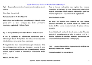 Apostila de Curso para Técnicas em Radiodiagnósticos Odontológicos
Fig.7 – Esquema Demonstrativo: Posicionamento na área de pré-
molares
(Face distal dos caninos)
Ponto de Incidência do Raio X Central
Para a região dos Pré-Molares é aconselhável que o Raio X Central
passe entre as faces contíguas dos dentes pré-molares
incidindona região do 2º Pré-Molar(Fig.8).
Fig. 8 - Radiografia Interproximal: Pré- Molares - Lado Esquerdo
A Fig. 8 apresenta as informações necessárias para a
interpretação (Laudo Radiográfico) das estruturas ósseas (cristas
interdentais) e a coroa dental (faces proximais).
A integridade das faces interproximais dos pré-molares e a distal
dos caninos permitem verificar que não existe a presença de lesão
de cárie. Dependendo do tamanho das coroas dentais dos primeiro
molares pode-se realizar a interpretação radiográfica destes
dentes.
REGIÃO DOS MOLARES
Para a tomada radiográfica das regiões dos molares
(Superiores e Inferiores), o Filme Radiográfico Interproximal
deve ser posicionado o mais posterior possível (face distal dos
molares) objetivando o enquadramento da região dental.
Posicionamento do filme
Ao tentar uma posição mais posterior do Filme poderá
provocar desconforto ou náuseas, devido ao contato das
bordas do filme com a mucosa na região de palato mole ou
assoalho
da cavidade bucal, resultando da não colaboração efetiva do
paciente. O enquadramento de todos os molares (1º, 2º e 3º
molares superiores e inferiores) dependerá do tamanho das
coroasdentais no sentido mesio – distal (Fig. 9).
Fig.9 - Esquema Demonstrativo: Posicionamento da área dos
Molares:(Face distal dos molares).
Ponto de Incidência do Raio X Central
Professora Mariana Marcelino – aulasaude@hotmail.com 27
 