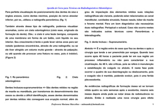 Apostila de Curso para Técnicas em Radiodiagnósticos Odontológicos
Para perfeita visualização do posicionamento dos dentes do siso e
órgãos anexos, como dentes visinhos, posição do nervo alveolar
inferior, por ex., utilizou a radiografia panorâmica. (fig. 1)
Também através desse tipo de radiografia, podemos visualizar
anomalias, como um cisto odontogênico (cisto esse, originado da
formação do dente). Obs.: o cisto é uma lesão benigna, composta
de uma membrana em forma de um balão, com líquido no seu
interior. Seu crescimento é lento e pode levar vários anos para ser
notado (podemos encontrá-los, através de uma radiografia; ou se
ele tiver atingido um volume muito grande - através da palpação;
ou até quando ele provocar uma fratura no osso, pois é indolor).
(Figura 2)
Fig. 1: Rx panorâmico Fig. 2: Cisto
odontogênico
Dentes Inclusos-supranumerários => São dentes retidos na região
da maxila ou mandíbula, por transtornos do desenvolvimento dos
ossos ou devido a difícil identificação, esses dentes denominados
por dentes retidos não conseguem sua erupção normal, além do
grau de impactação dos elementos retidos suas relações
radiográficas são visíveis, podendo estar relacionados ao canal
mandibular, cavidades sinusiais, fossas nasais, túber da maxila
e forame mental. Para um bom diagnóstico são necessárias
duas radiografias: Periapical e oclusal. Caso não ocorra nestes
são indicados outras técnicas como Panorâmicas e
teleradiografia.
Fig. 3: dente Incluso – Supranumerário.
Alvéolo => É a região entre do osso que fixa os dentes e após a
cirurgia que tende a ser preenchida por sangue. Quando isso
ocorre após 48 horas o paciente pode ter em sua região um
processo inflamatório ou não para caracterizar a sua
cicatrização. As 48 h. são críticas, pois se refere à manutenção
e estabilização do coágulo no alvéolo. E nesta fase pode
ocorrer o quadro de sua desintegração ou deslocamento, pois
o coagulo não é mantido, podendo evoluir, pois é uma ferida
pós-exodontia.
As evidências radiográficas de formação óssea só se tornam
nítida quatro ou seis semanas após a exodontia, mesmo seis
meses depois ainda pode se notar áreas de radiolucência no
alvéolo. Então é realizada uma nova cirurgia para efeito
Professora Mariana Marcelino – aulasaude@hotmail.com 9
 