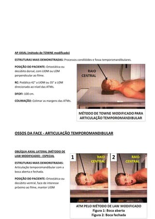 137
AP AXIAL (método de TOWNE modificado)
ESTRUTURAS MAIS DEMONSTRADAS: Processos condilóides e fossa temporomandibulares.
POSIÇÃO DO PACIENTE: Ortostática ou
decúbito dorsal, com LIOM ou LOM
perpendicular ao filme.
RC: Podálico 42° a LIOM ou 35° a LOM
direcionado ao nível das ATMs.
DFOFI :100 cm.
COLIMAÇÃO: Colimar as margens das ATMs.
OSSOS DA FACE - ARTICULAÇÃO TEMPOROMANDIBULAR
OBLÍQUA AXIAL LATERAL (MÉTODO DE
LAW MODIFICADO) - ESPECIAL
ESTRUTURAS MAIS DEMONSTRADAS:
Articulação temporomandibular com a
boca aberta e fechada.
POSIÇÃO DO PACIENTE: Ortostática ou
decúbito ventral, face de interesse
próximo ao filme, manter LIOM
 
