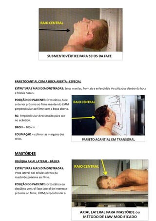141
PARIETOCANTIAL COM A BOCA ABERTA - ESPECIAL
ESTRUTURAS MAIS DEMONSTRADAS: Seios maxilas, frontais e esfenoidais visualizados dentro da boca
e fossas nasais.
POSIÇÃO DO PACIENTE: Ortostática, face
anterior próxima ao filme mantendo LMM
perpendicular ao filme com a boca aberta.
RC: Perpendicular direcionado para sair
no acântion.
DFOFI – 100 cm.
COLIMAÇÃO – colimar as margens dos
seios.
MASTÓIDES
OBLÍQUA AXIAL LATERAL - BÁSICA
ESTRUTURAS MAIS DEMONSTRADAS:
Vista lateral das células aéreas da
mastóide próxima ao filme.
POSIÇÃO DO PACIENTE: Ortostática ou
decúbito ventral face lateral de interesse
próxima ao filme, LIOM perpendicular à
 
