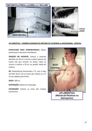 24
AP LORDÓTICA - TAMBÉM CHAMADO DE MÉTODO DE FLEISHNER ou APICOGRAMA - ESPECIAL
ESTRUTURAS MAIS DEMONSTRADAS: Ápices
pulmonares e derrames interlobares.
POSIÇÃO DO PACIENTE: Colocar o paciente
afastado em 30 cm e inclinar a parte superior do
tronco até que encoste no bucky, mãos na
cintura e ombros a 20 cm na porção média do
esterno.
RC: Perpendicular direcionado a T7, com o topo
do filme de 8 a 10 cm acima dos ombros ou a 9
cm da rodados para frente.
DFOFI: 180 cm.
RESPIRAÇÃO: Apnéia em inspiração.
COLIMAÇÃO: Colimar as áreas dos campos
pulmonares.
 