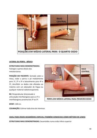 68
LATERAL OU PERFIL - BÁSICA
ESTRUTURAS MAIS DEMONSTRADAS:
Falanges e partes distais dos
metatarsianos.
POSIÇÃO DO PACIENTE: Sentado sobre a
mesa, rodar a perna e pé medialmente
para 1º, 2º e 3º e lateralmente para 4º e
5º, dorsifletir os dedos não afetados ao
máximo com um abaixador de língua ou
qualquer material radiotransparente.
RC: Perpendicular direcionado à
articulação interfalangiana para o 1º e
interfalangiana proximal do 2º ao 5º.
DFOFI: 100 cm.
COLIMAÇÃO: Colimar toda área de interesse.
AXIAL PARA OSSOS SESAMÓIDES-ESPECIAL (TAMBÉM CONHECIDA COMO MÉTODO DE LEWIS)
ESTRUTURAS MAIS DEMONSTRADAS: Sesamóides numa visão ínfero-superior
 