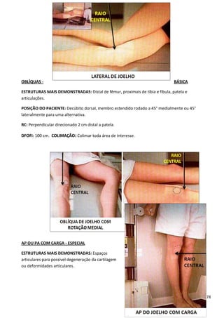 78
OBLÍQUAS - BÁSICA
ESTRUTURAS MAIS DEMONSTRADAS: Distal de fêmur, proximais de tíbia e fíbula, patela e
articulações.
POSIÇÃO DO PACIENTE: Decúbito dorsal, membro estendido rodado a 45° medialmente ou 45°
lateralmente para uma alternativa.
RC: Perpendicular direcionado 2 cm distal a patela.
DFOFI: 100 cm. COLIMAÇÃO: Colimar toda área de interesse.
AP OU PA COM CARGA - ESPECIAL
ESTRUTURAS MAIS DEMONSTRADAS: Espaços
articulares para possível degeneração da cartilagem
ou deformidades articulares.
 