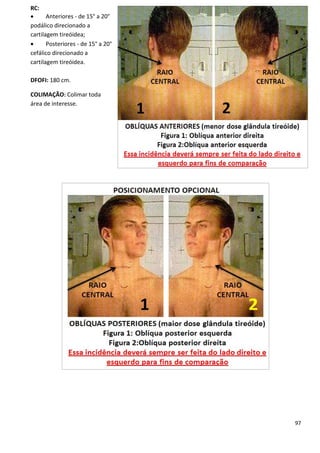 97
RC:
 Anteriores - de 15° a 20°
podálico direcionado a
cartilagem tireóidea;
 Posteriores - de 15° a 20°
cefálico direcionado a
cartilagem tireóidea.
DFOFI: 180 cm.
COLIMAÇÃO: Colimar toda
área de interesse.
 