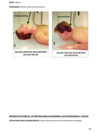 100
DFOFI: 100 cm.
COLIMAÇÃO: Colimar toda área de interesse.
MÉTODO DE OTTONELLO - AP COM OSCILAÇÃO DA MANDÍBULA (AUTOTOMOGRAFIA) - ESPECIAL
ESTRUTURAS MAIS DEMONSTRADAS: Toda coluna cervical com borramento da mandíbula.
 