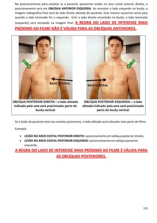 121
No posicionamento para costelas se o paciente apresentar lesões no arco costal anterior direito, o
posicionamento será em OBLÍQUA ANTERIOR ESQUERDA. Ao encostar o lado esquerdo no bucky, a
imagem radiográfica final será do lado direito afetado do paciente. Esse mesmo raciocínio serve para
quando o lado lesionado for o esquerdo. Com o lado direito encostado no bucky, o lado lesionado
(esquerdo) será retratado na imagem final. A REGRA DO LADO DE INTERESSE MAIS
PRÓXIMO AO FILME NÃO É VÁLIDA PARA AS OBLÍQUAS ANTERIORES.
Se a lesão do paciente está nas costelas posteriores, o lado afetado será colocado mais perto do filme.
Exemplo:
 LESÃO NO ARCO COSTAL POSTERIOR DIREITO: posicionamento em oblíqua posterior direita;
 LESÃO NO ARCO COSTAL POSTERIOR ESQUERDO: posicionamento em oblíqua posterior
esquerda;
A REGRA DO LADO DE INTERESSE MAIS PRÓXIMO AO FILME É VÁLIDA PARA
AS OBLÍQUAS POSTERIORES.
 